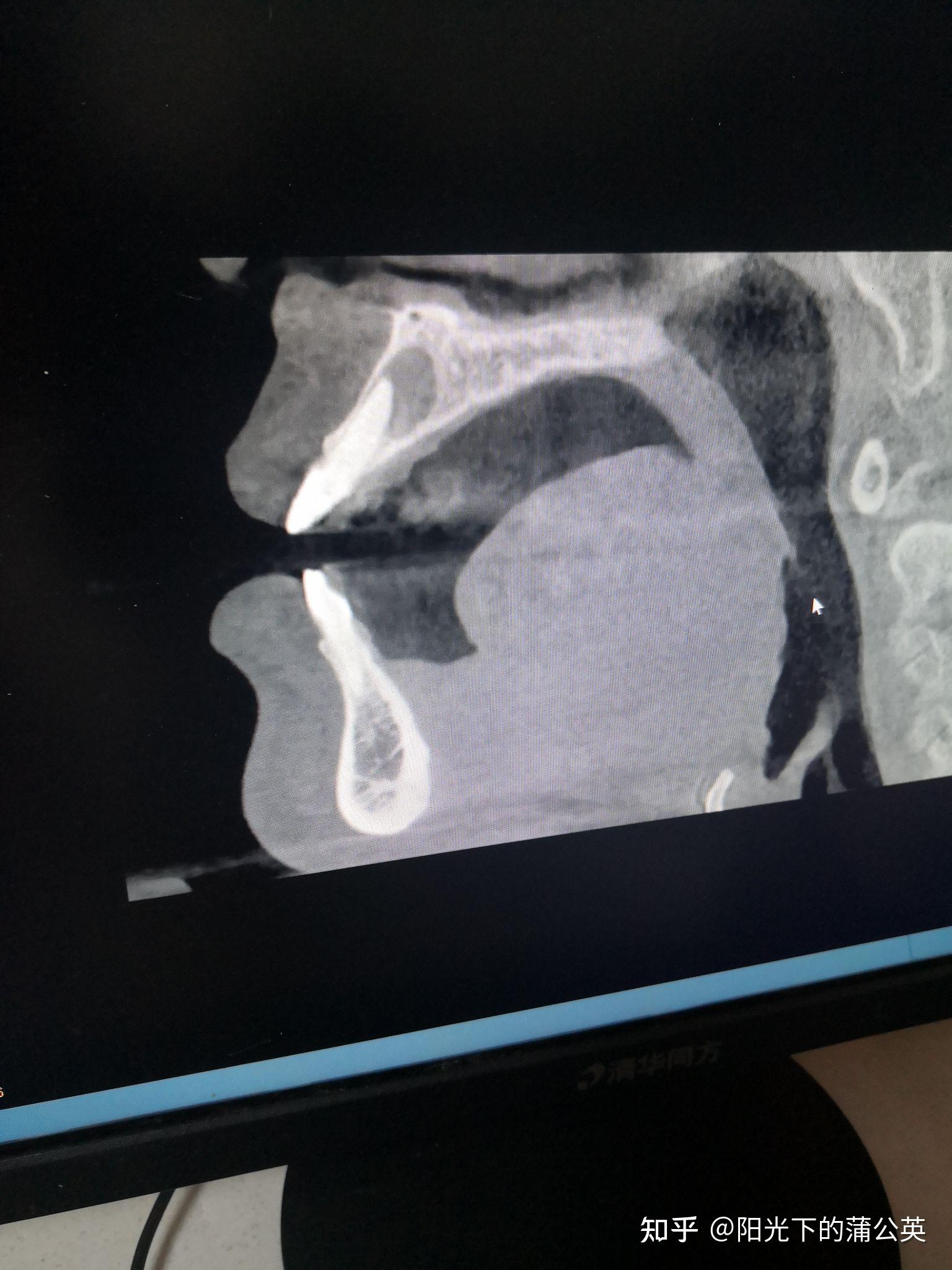 分享全麻刮根尖囊肿拔三颗门牙的简单记忆