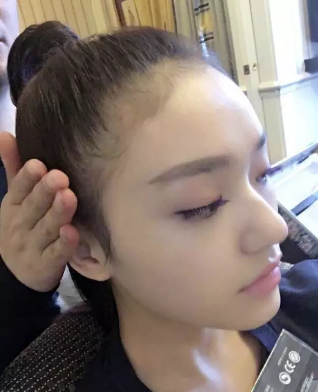 脱发戴假发好吗