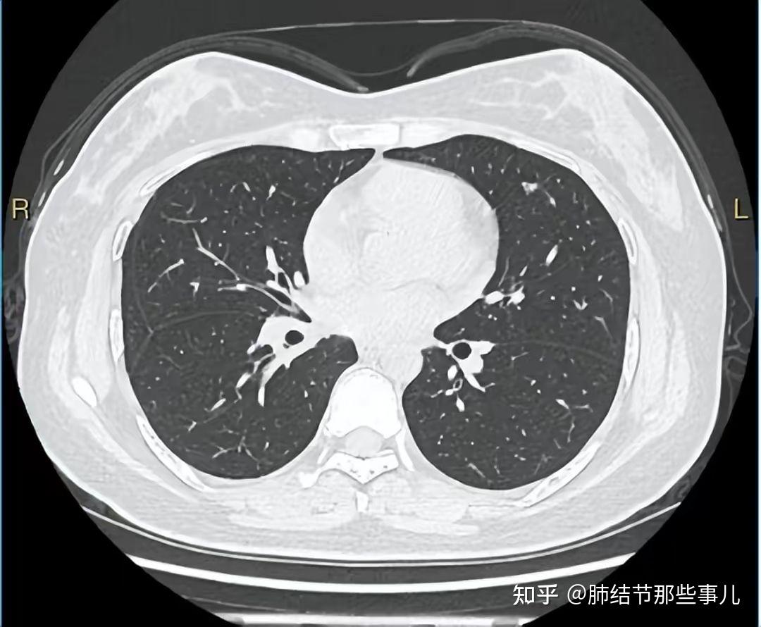 2022-03-21左肺上葉舌段1.0*0.9混雜密度結節,求戴主任幫忙定性.2020.