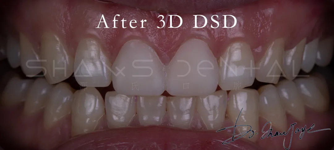 病例赏析 || 瓷贴面美学修复改变前牙形态 爱迪特 aidite - 知乎