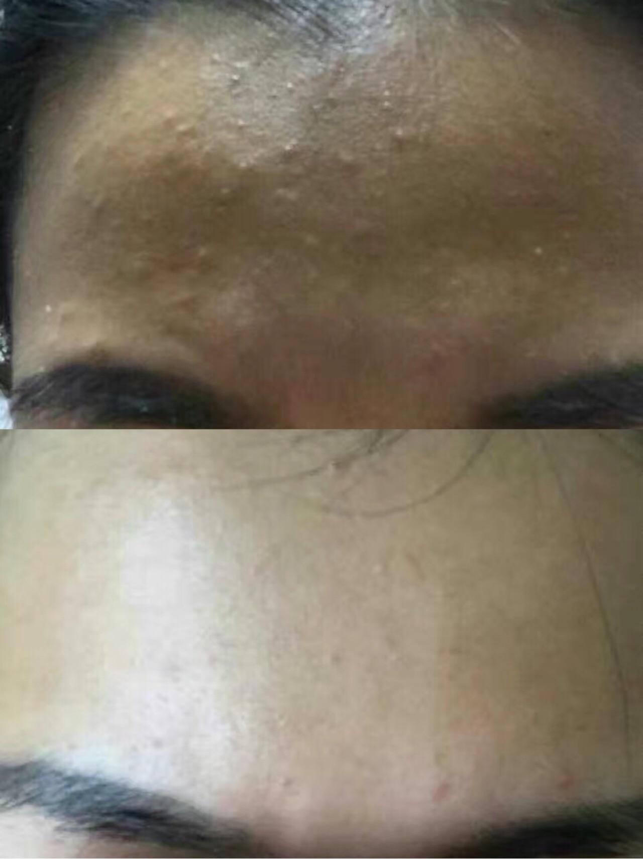 额头上的是闭口吗?怎么祛除?