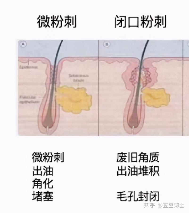 粉刺是怎么形成的图片图片