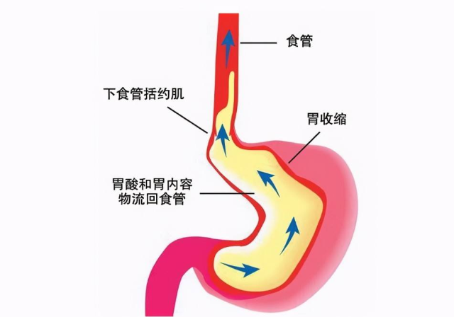 只是胃反流不痛不痒长期反流远比你想象的更可怕