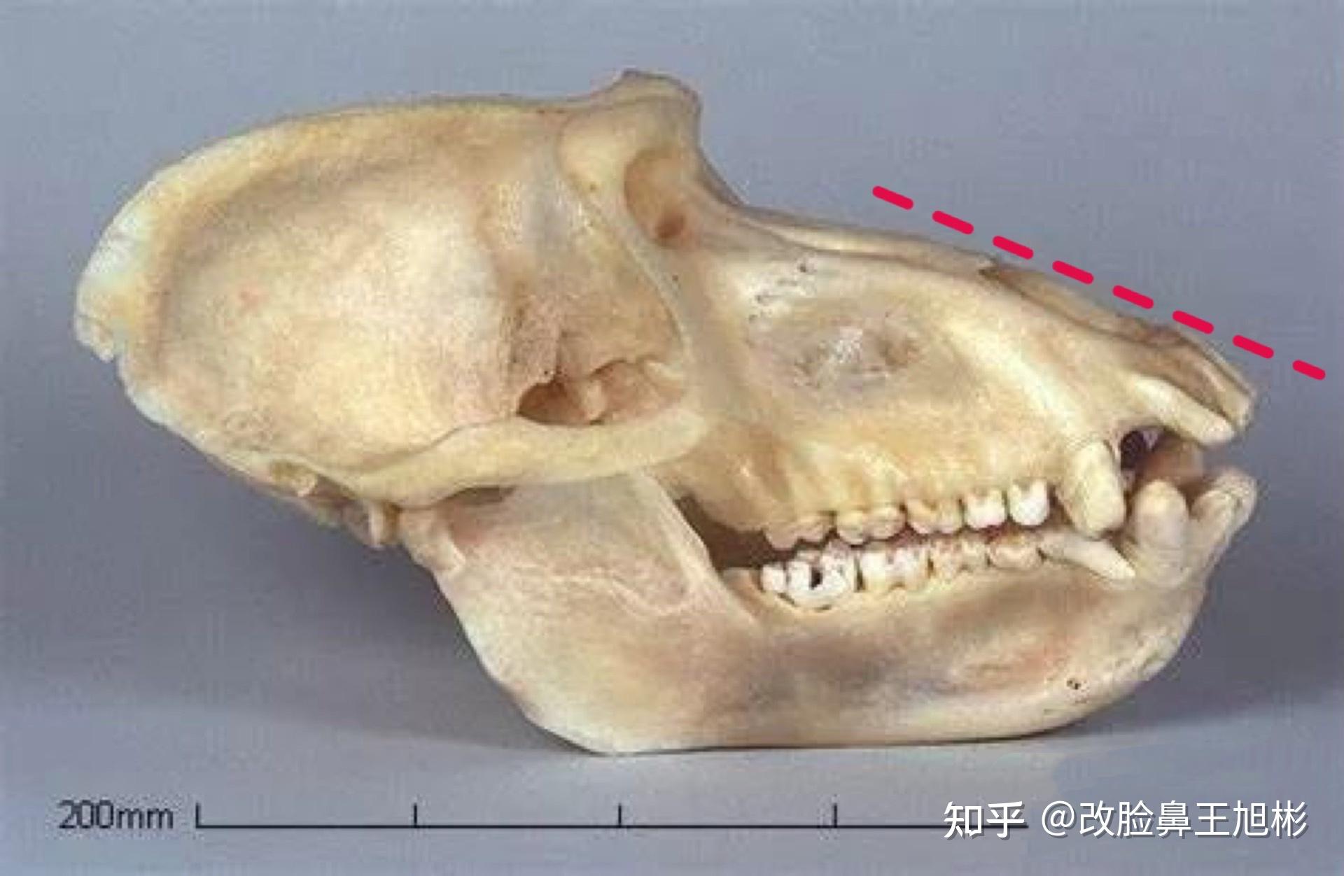 鼻基底填充後為什麼會變成猴子