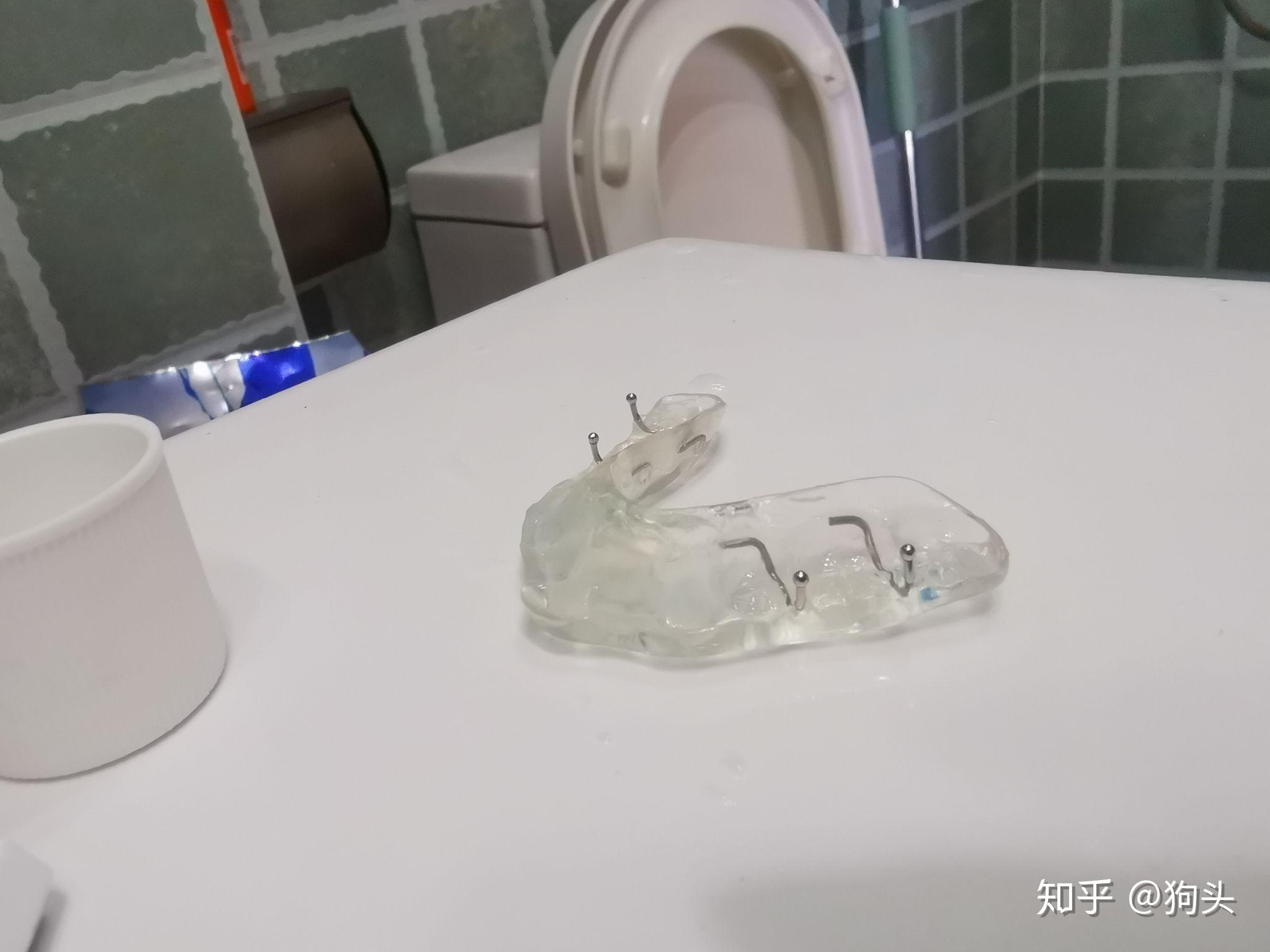 门牙根管带冠补牙关节弹响深覆合二次矫正2020年记事发现牙问题后的