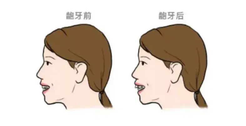 下頜後縮口呼吸時顎穹隆高拱妨礙了硬顎的正常下降由於氣道從口腔通過