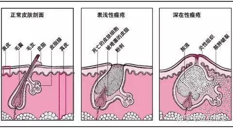 痘痘反复生长,那是痘根在作怪! - 知乎