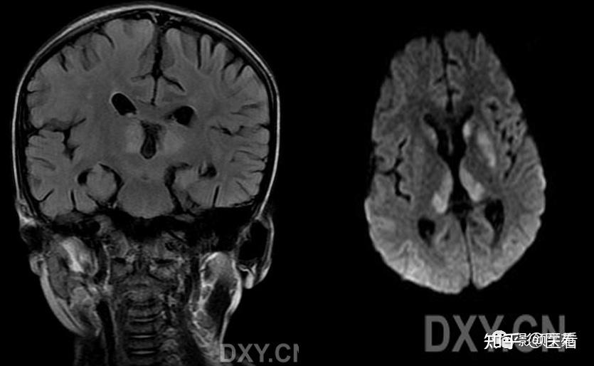 wernicke脑病mri表现