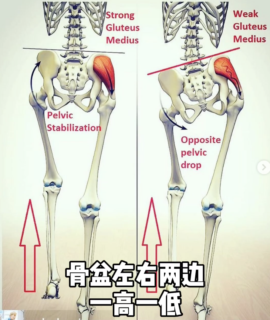 骨盆不正 很影响腰痛 腰骶疼痛 知乎