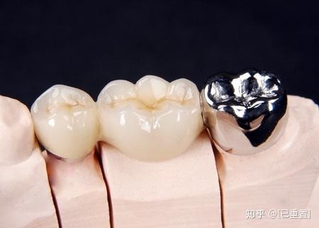 门头沟口腔健康:烤瓷牙与全瓷牙的区别和优缺点