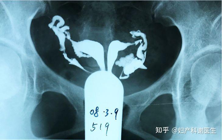 3,縱膈子宮2,單角子宮1,雙子宮以下分享一些常見的子宮和輸卵管異常的