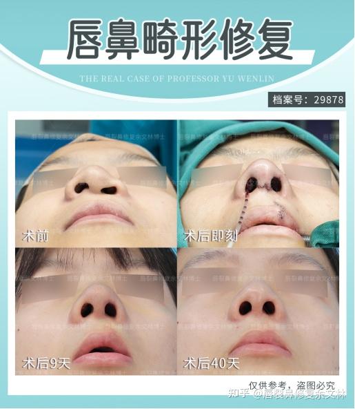 唇鼻修复术后多久可以正常上班? - 知乎