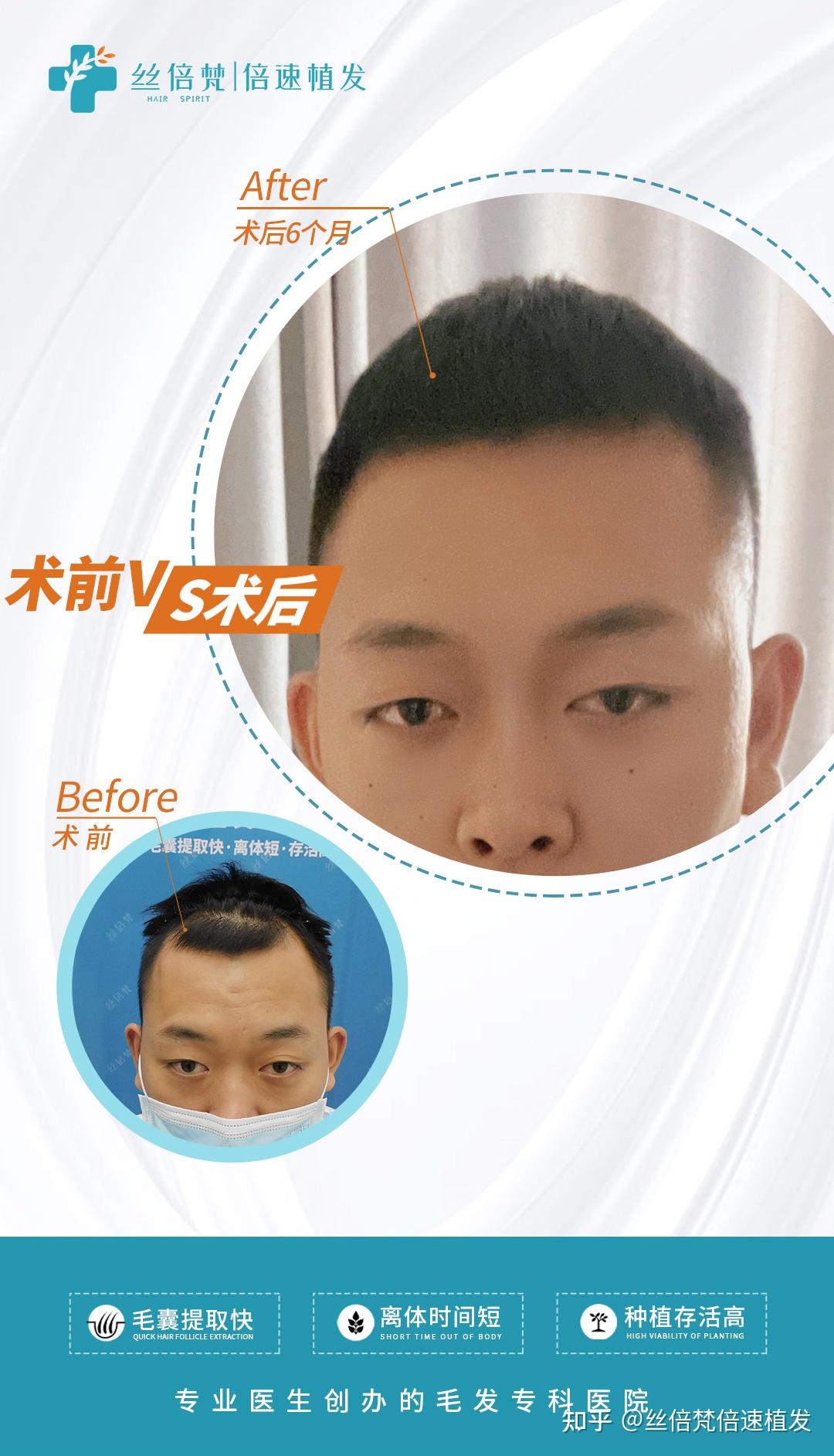 丝倍梵植发医院王禹医生科普植发靠谱么