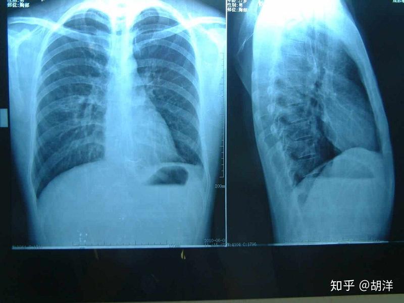 肺结核患者病灶中出现了钙化意味着什么,居然