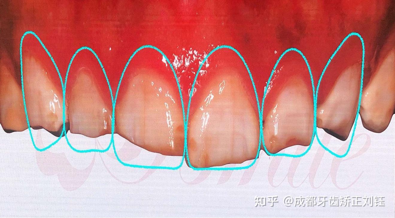 更重要的是,正畸治疗能够平整前牙牙龈缘高度,消除过度牙龈暴露,关闭