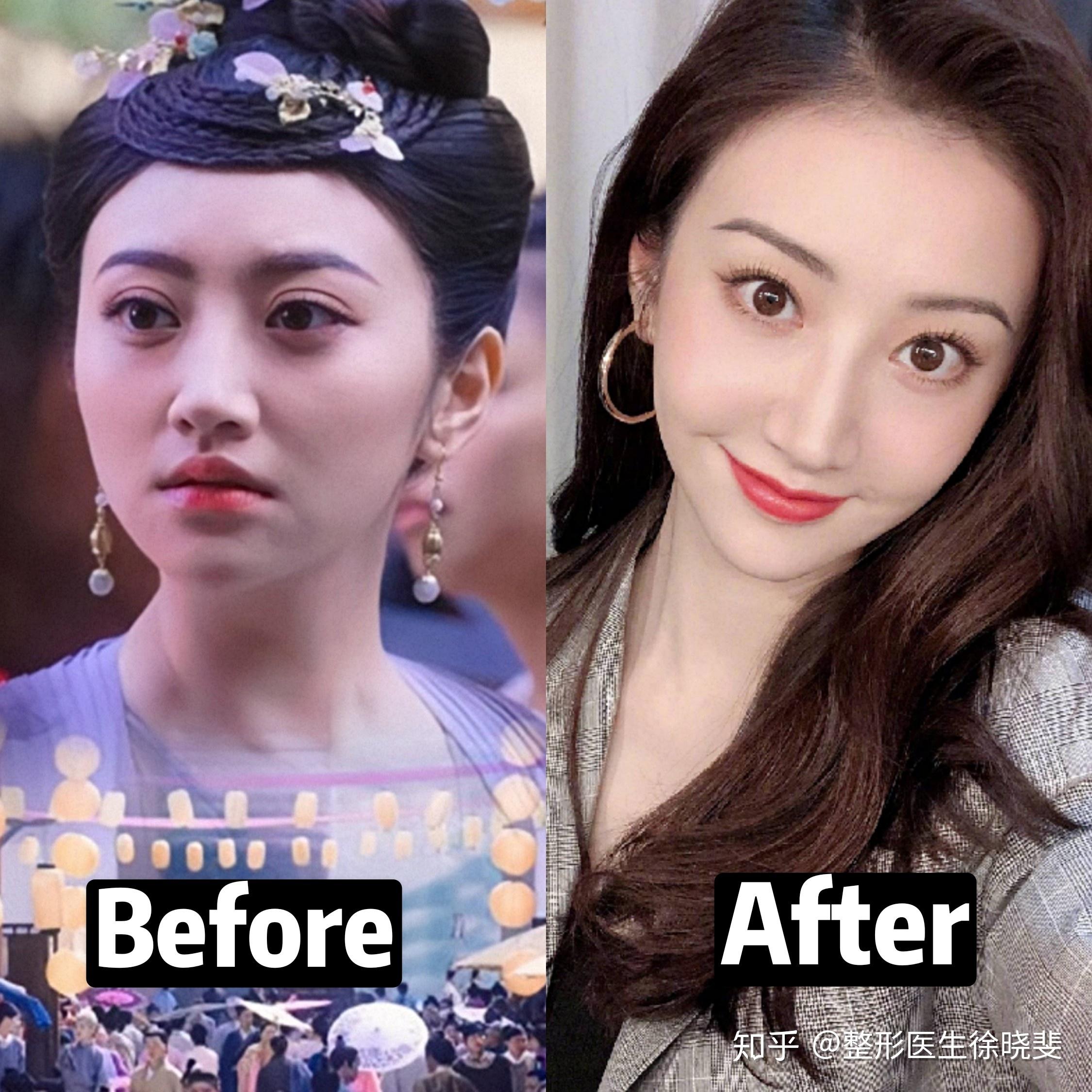 景甜说自己做埋线变成悲伤蛙讲真她现在修复的效果好不好