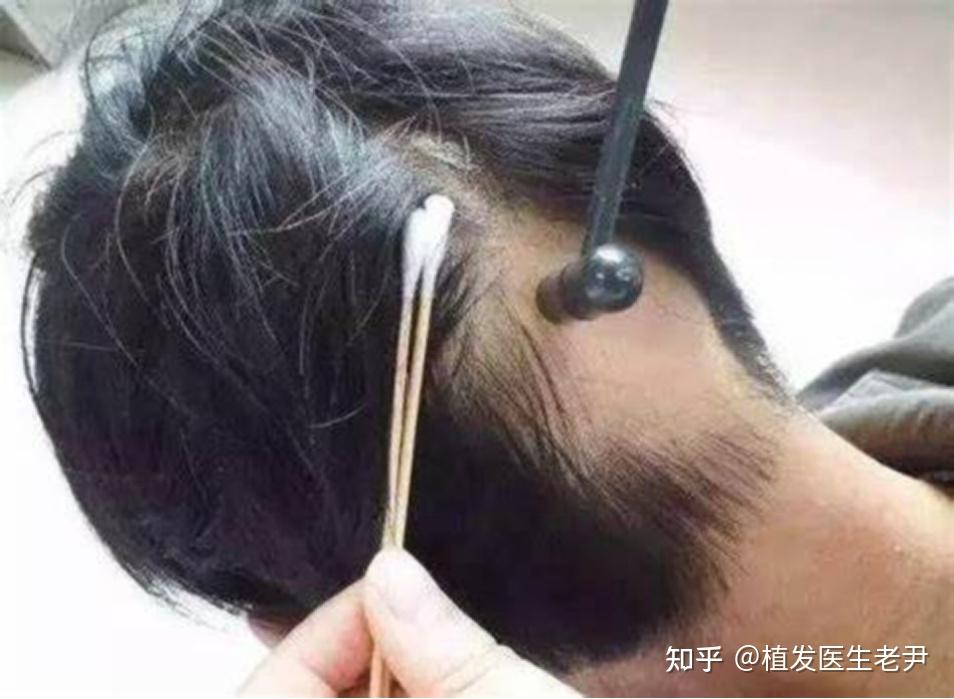 梅花针治疗脱发有用吗? - 知乎