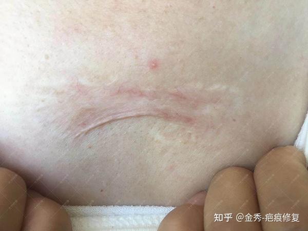 辽宁姬女士前胸疤痕疙瘩治疗案例 