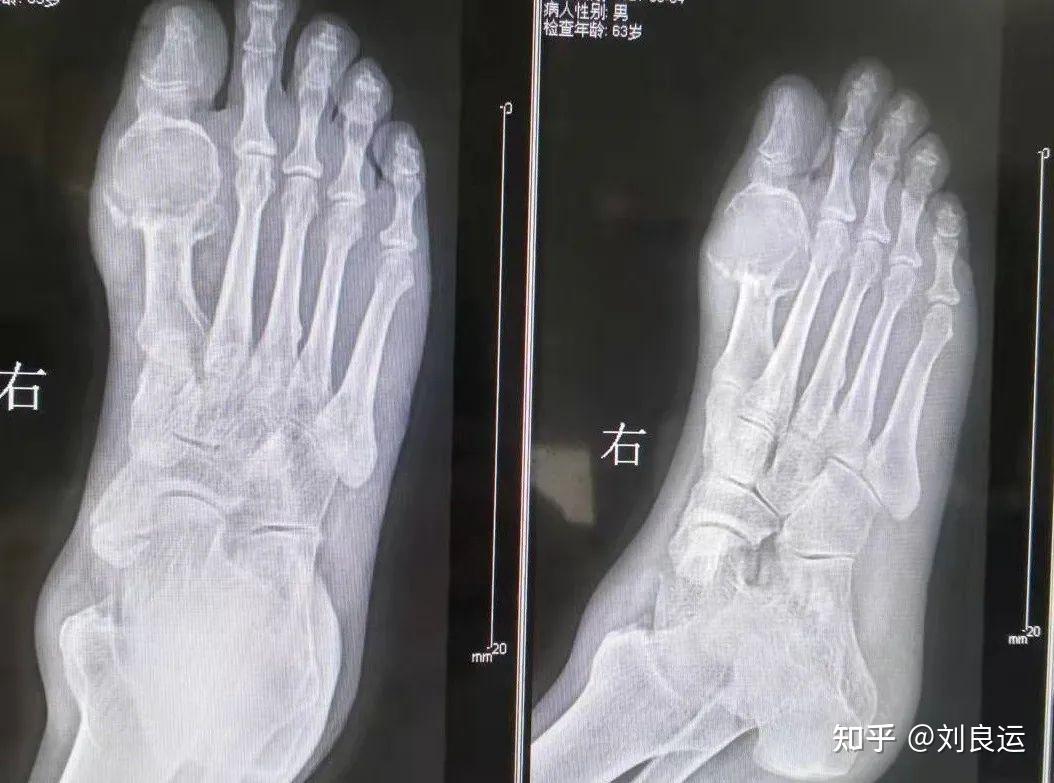 中药降尿酸没有副作用?医生辟谣,中药治痛风也不是千人一方