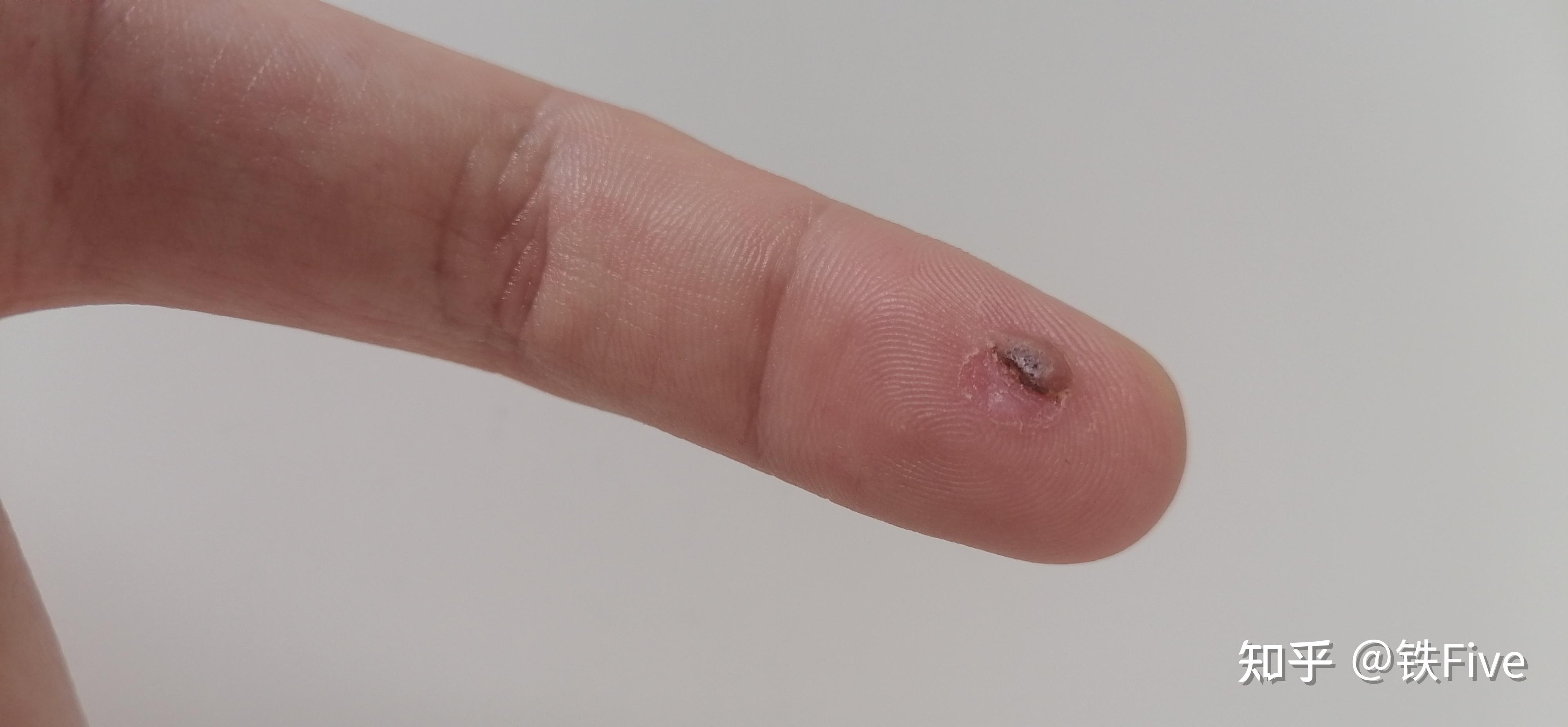 15,第八天当时医生说硬了就可以碰水了,这都硬好几天了,昨天泡了下水