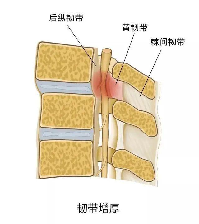 当脊柱出现退化不稳定时,黄韧带及后纵韧带受到的应力增高,常常会导致