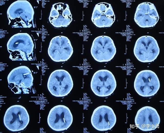 近致命性结核脑膜炎性脑积水发病后2个月内先后经4家医院治后仍无改善