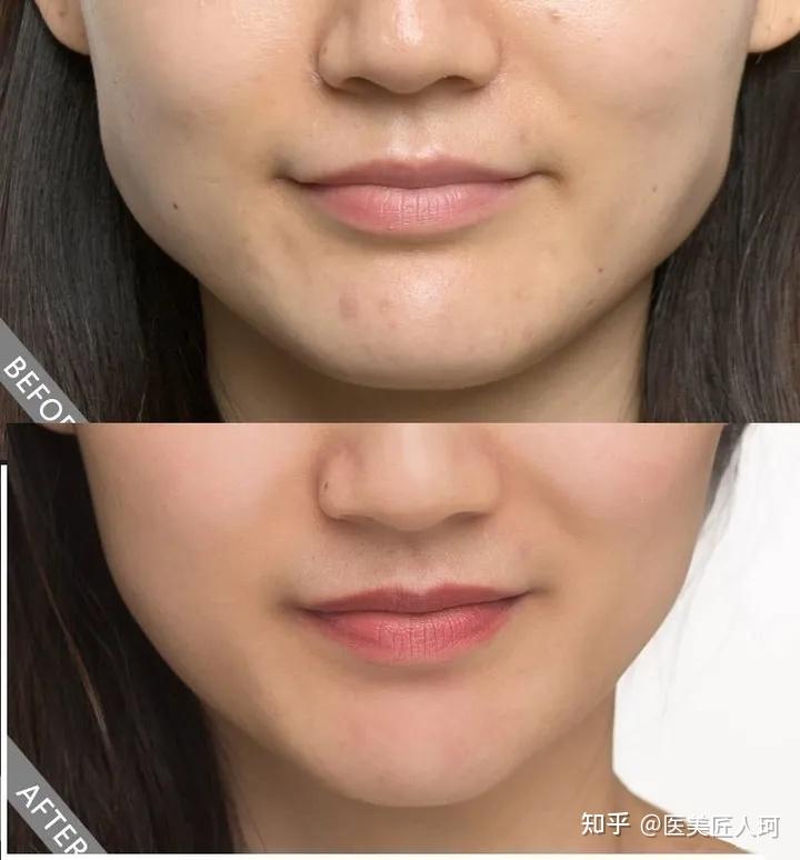 但是,如果你颊脂肪垫肥厚,不能用吸脂改善,可能需要做手术去除,由于