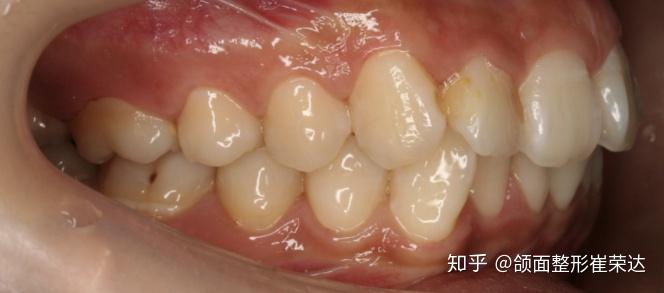 骨性龅牙还是牙性龅牙看这3点就知道了