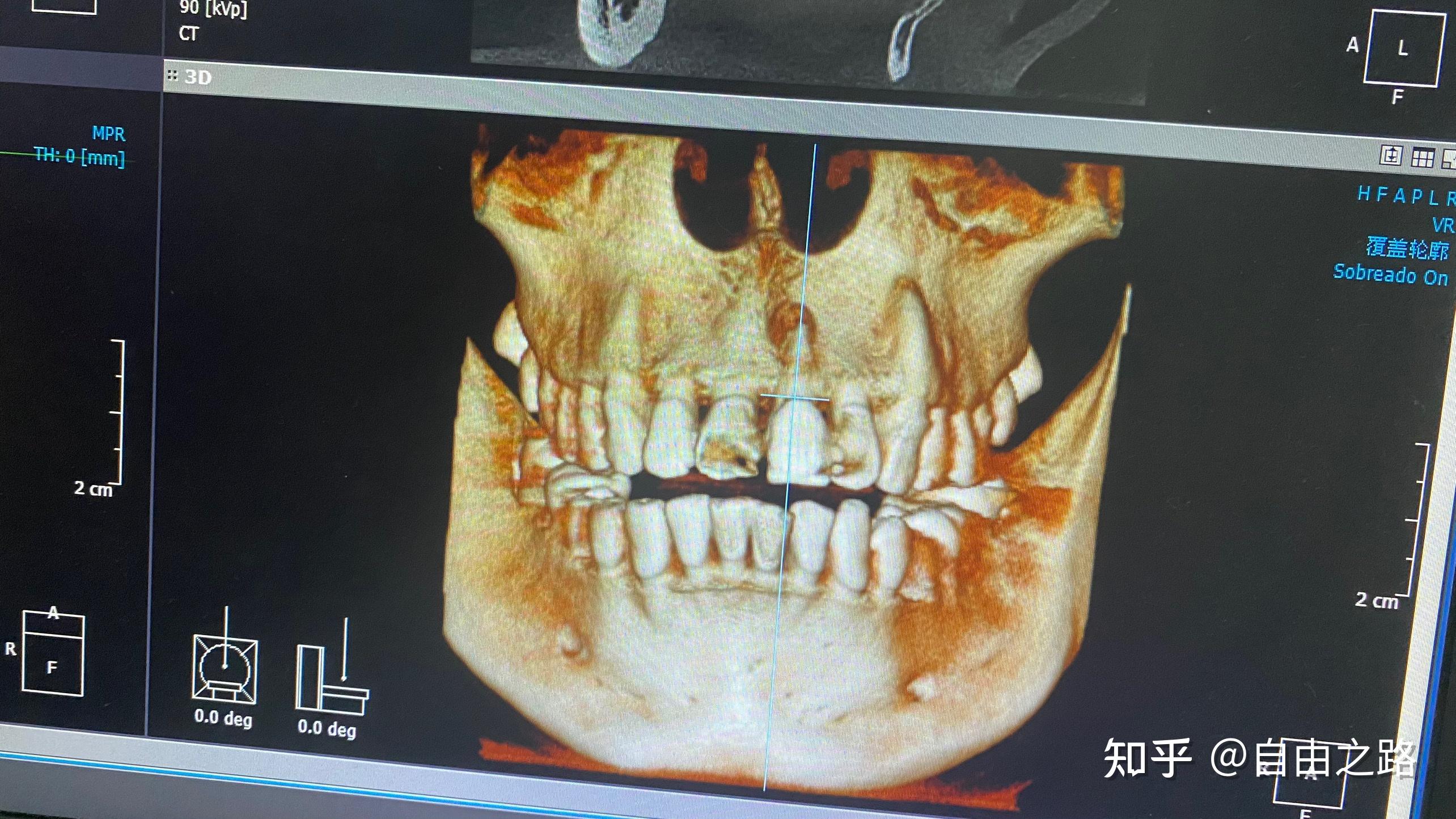 補牙肉手術拯救牙齦萎縮 提升植牙成功率 - 米羅牙醫診所