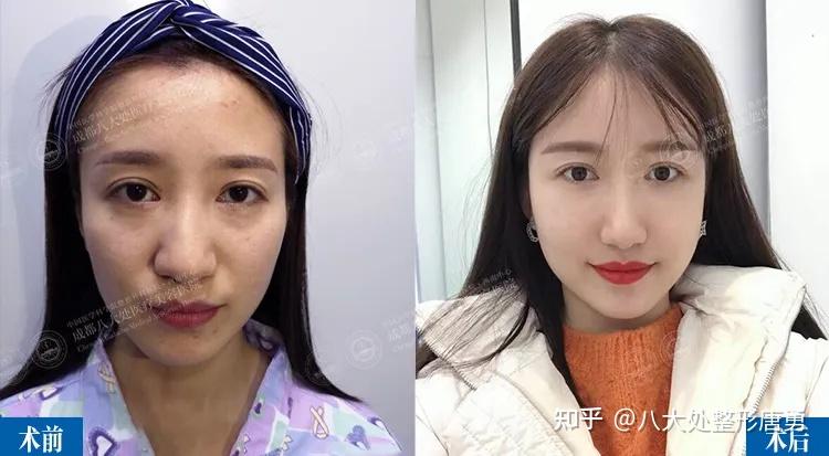面部凹陷是初老的表现,为什么会出现面部凹陷?凹陷的脸该如何回到从前? - 知乎