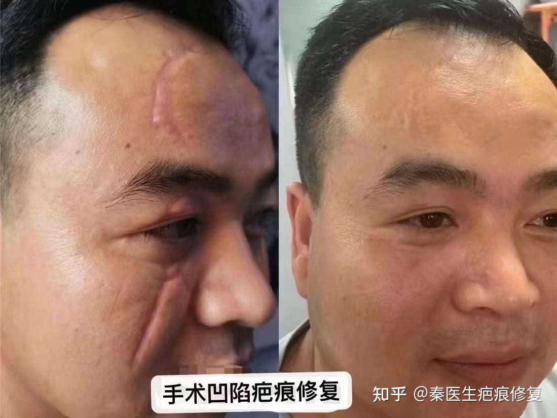 手术缝针12年后留下的凹陷线状疤痕怎么办? ? - 知乎