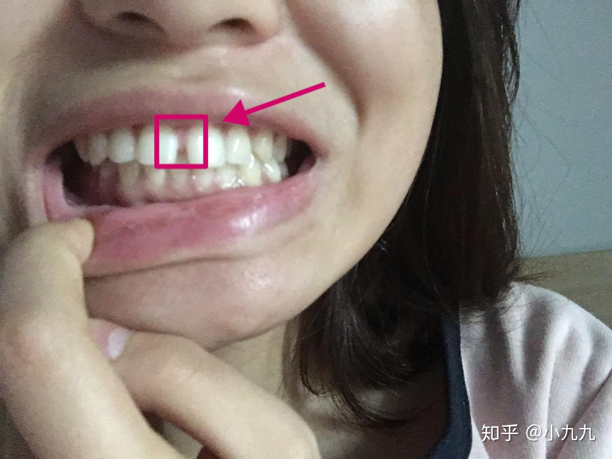 牙齿缝隙大如何矫正(门牙缝隙变大什么原因) - 科猫网