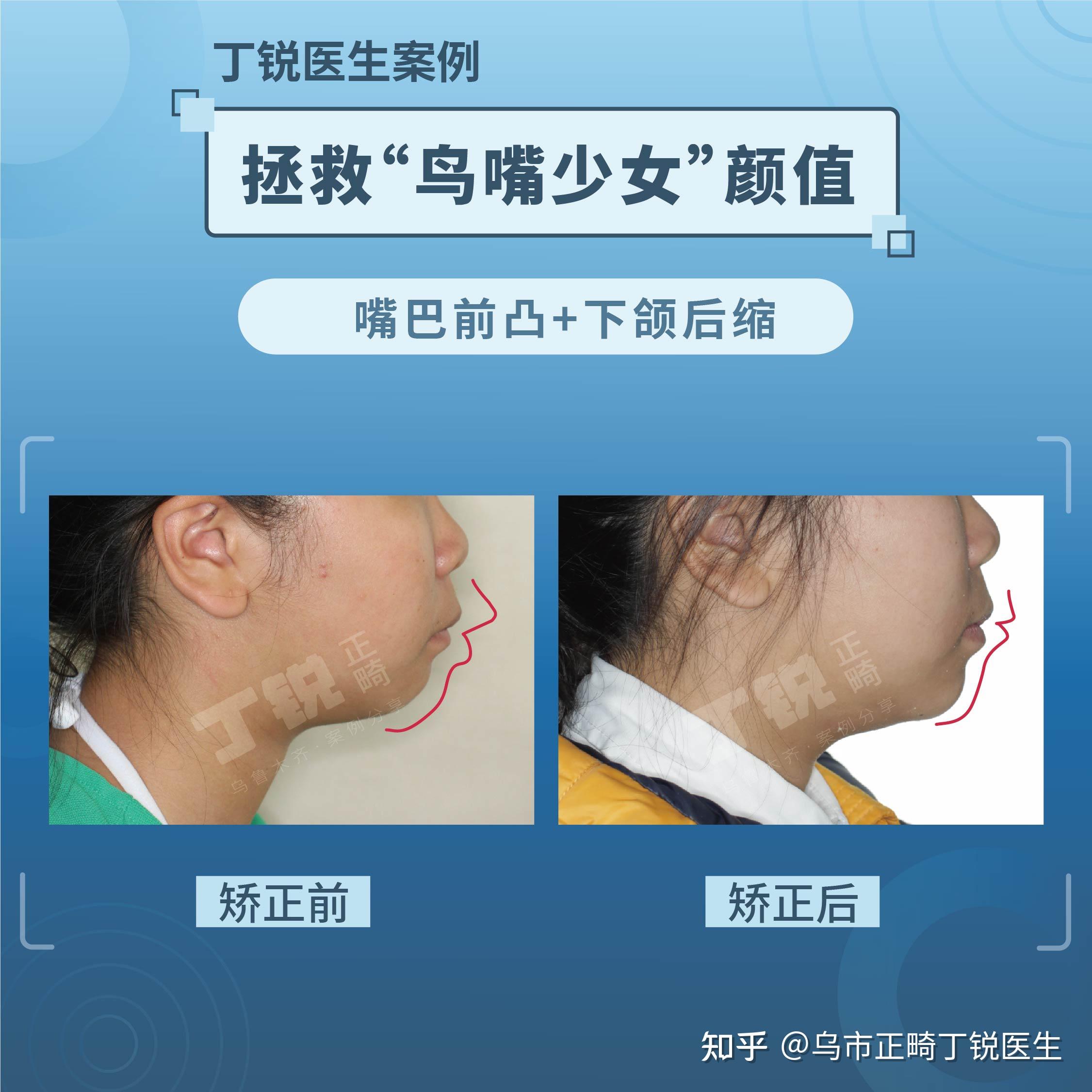 鸟嘴的人面相图片图片