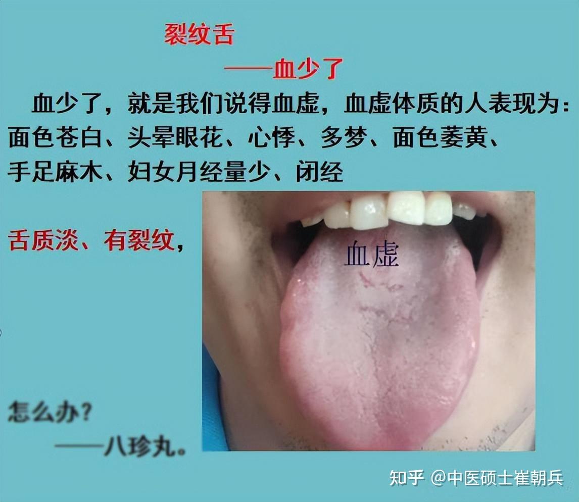 舌头有裂纹一定是阴虚？分享3种治疗方案，散尽天下“裂纹舌” - 知乎