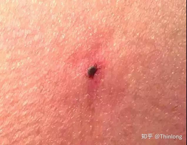 被蜱虫叮咬,该怎么办?