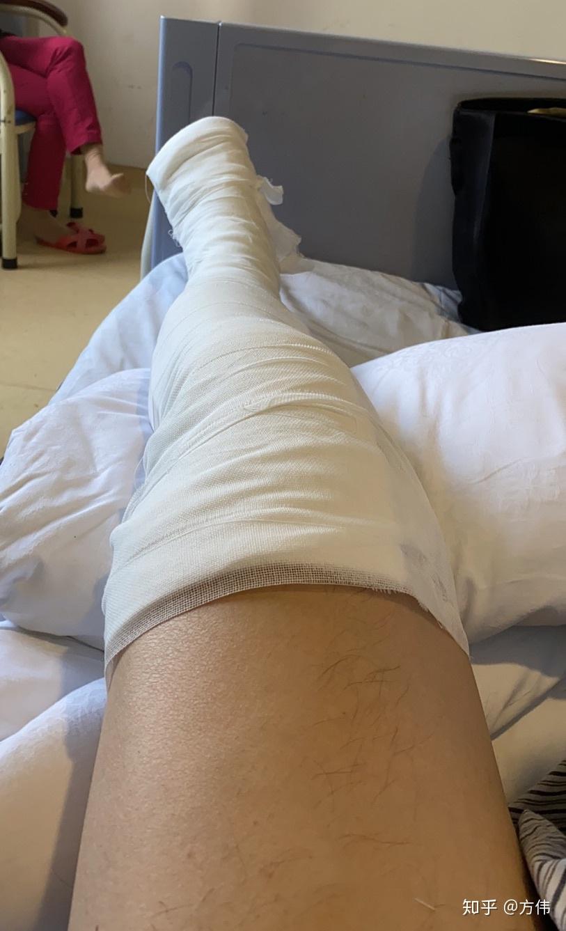 跟腱断裂跟科比有同一伤病是种什么体验