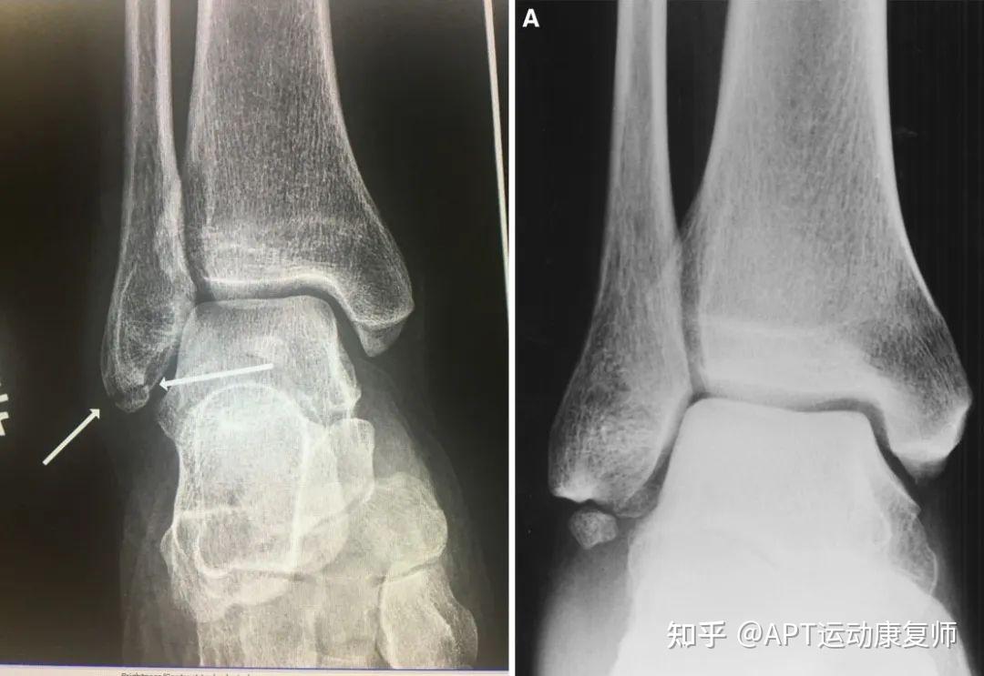 干货|崴脚导致踝撕脱性骨折,4周实现从轮椅到自由走动 - 知乎