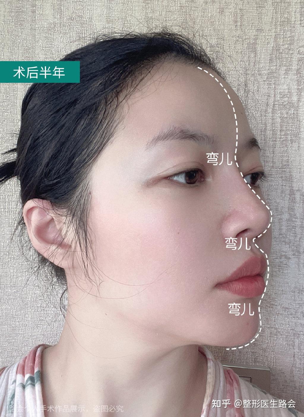 异体骨隆鼻后鼻尖被弄丢了全膨体鼻修复后求美者重回自信