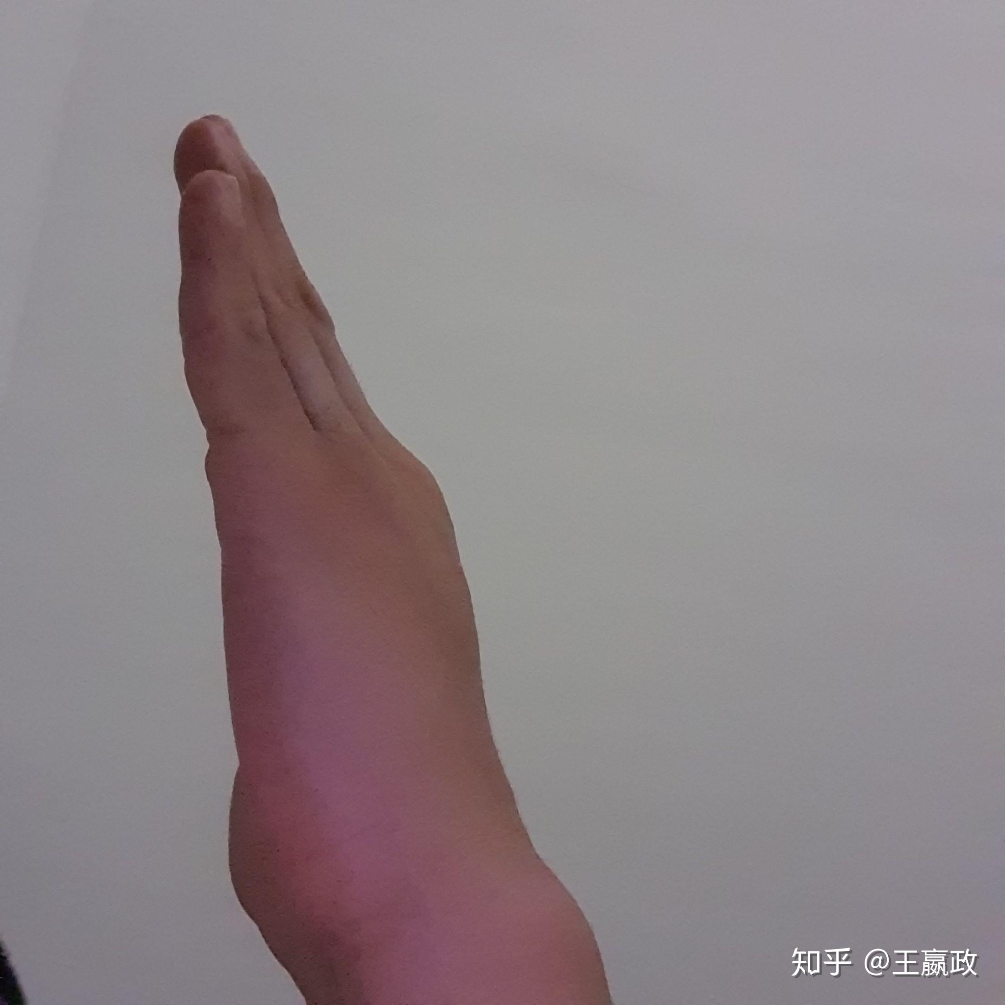 是手腕外侧靠近小指 而且左右手都有好久了按下去不痛. - 知乎