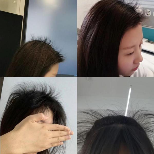 头发由少变多的过程分享 - 知乎
