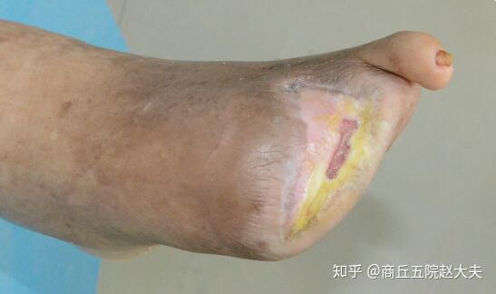 糖尿病足的干性坏疽与治疗