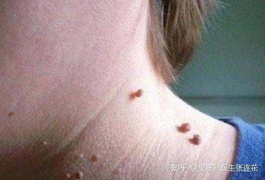 “疣”是什么病?疣的分类及治疗!你想知道的都在这儿 - 知乎