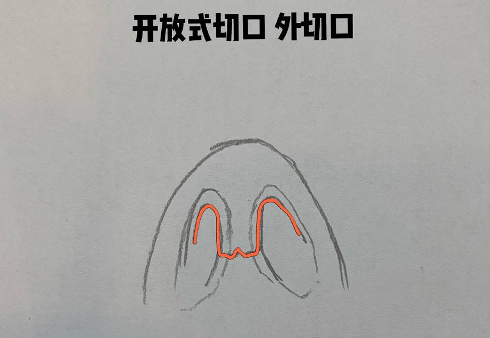 隆鼻手术切口是什么样的?可以自己选择吗? - 知乎