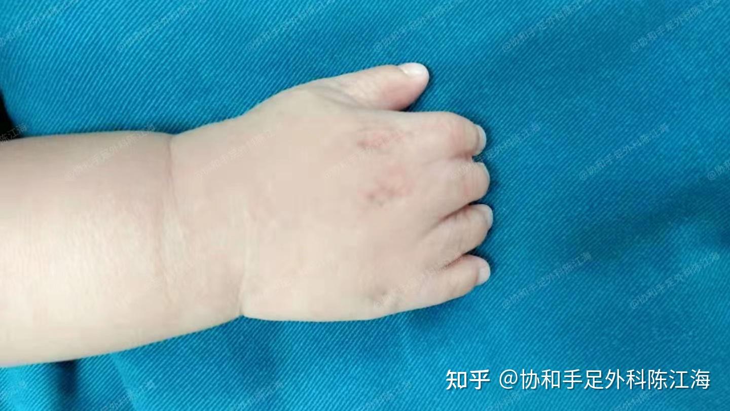 并指畸形有几种类型?医生:一般可分为这4种! - 知乎