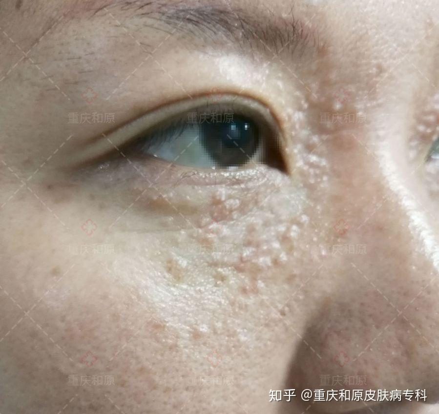 眼下痘痘你知多少