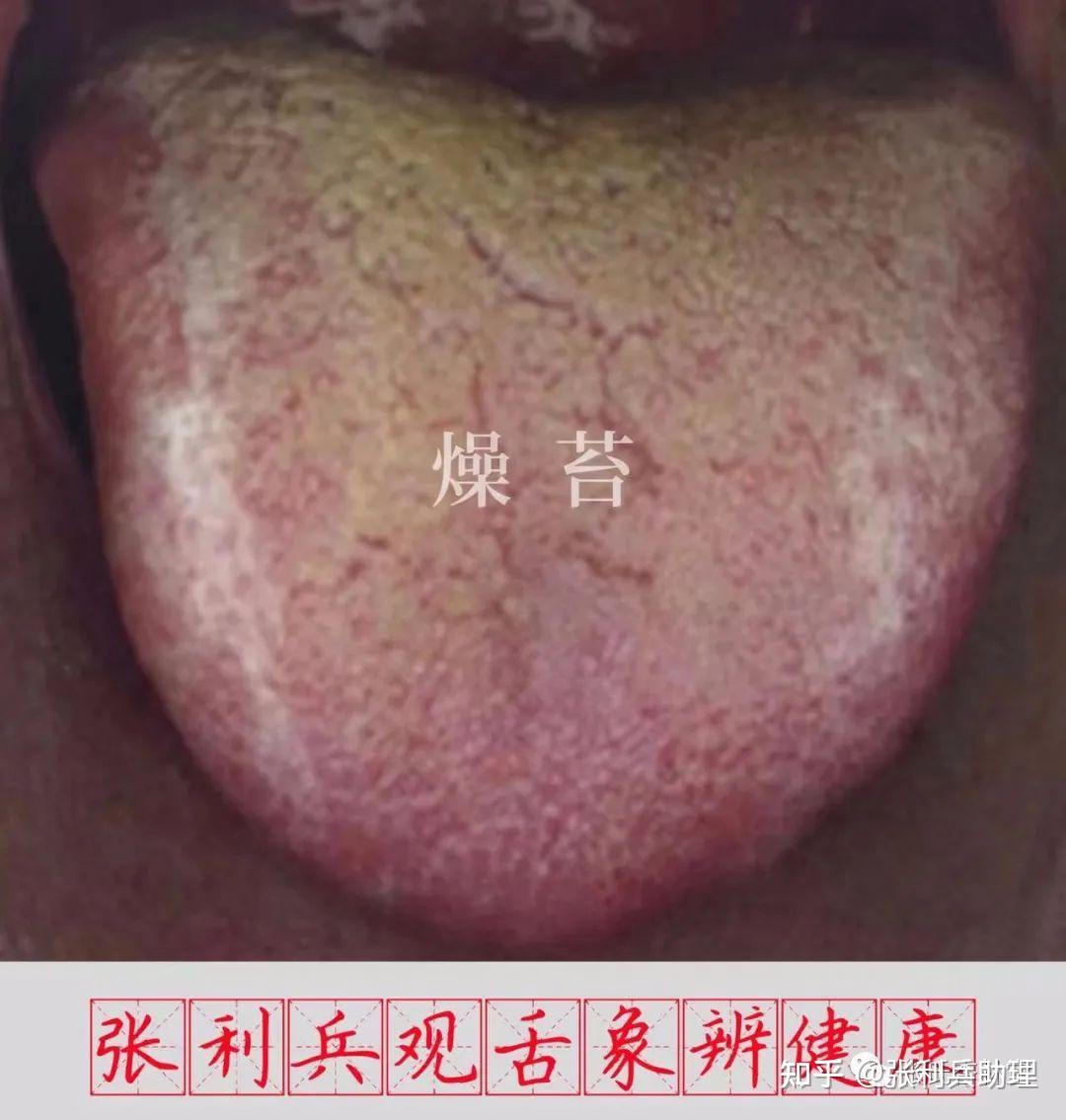 张利兵:“观舌象辨健康”第32讲--舌苔辨证诊病之润苔与燥苔 - 知乎