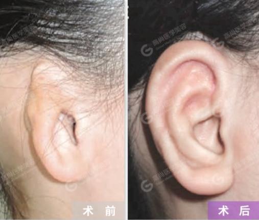 耳朵缺一块怎么修补耳廓缺损修复了解一下