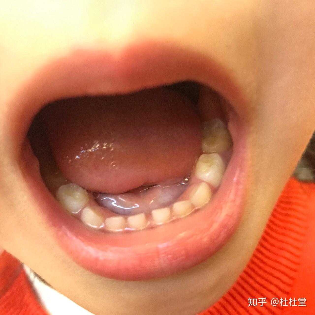 6岁半小孩乳牙自己移动，是里面长新牙了吗？_百度知道