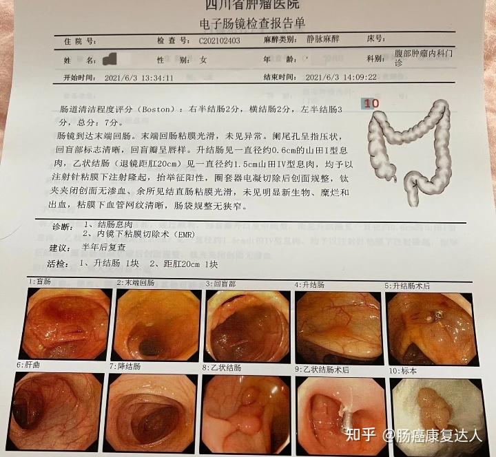 确诊肠癌怎么办系列之《二》中晚期转院诊疗的决策依据 