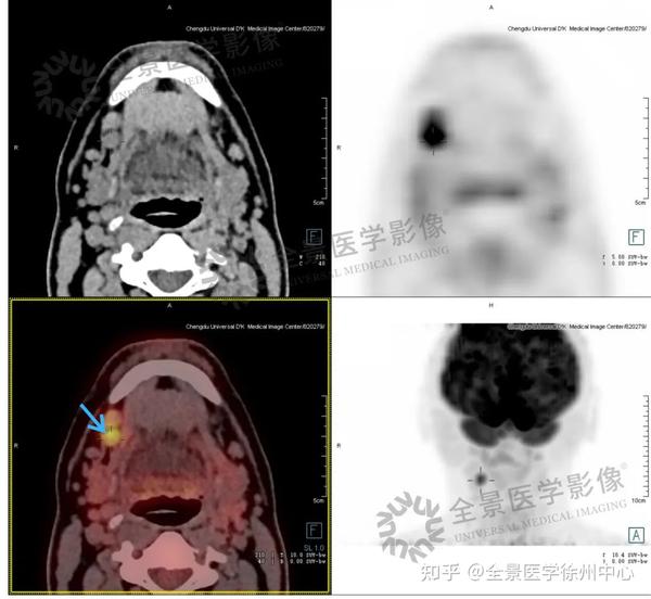 “口腔溃疡”一个多月不见好,竟然是舌癌! - 知乎